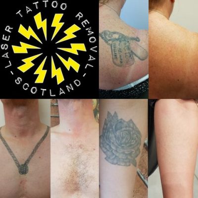 £500 Laser Tattoo Removal Scotland Voucher